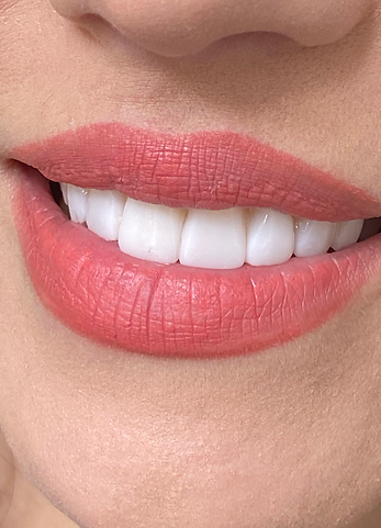 бондинг, избелване на зъби, почистване на зъби, след лечението