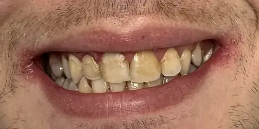 Бондинг, случай на бондинг, преди лечението