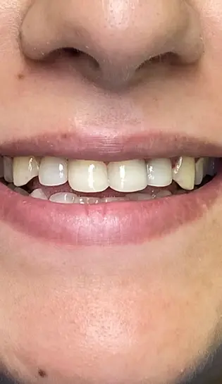 Бондинг, случай на бондинг, след лечението