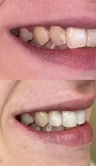 Бондинг, случай на бондинг, преди и след лечението