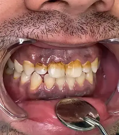 Бондинг, случай на бондинг, преди лечението