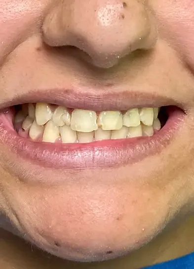 Бондинг, случай на бондинг, преди лечението