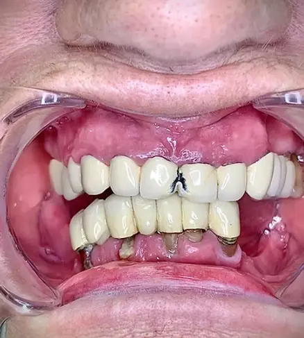 дентална естетика, поставяне на коронки, протези, преди лечението