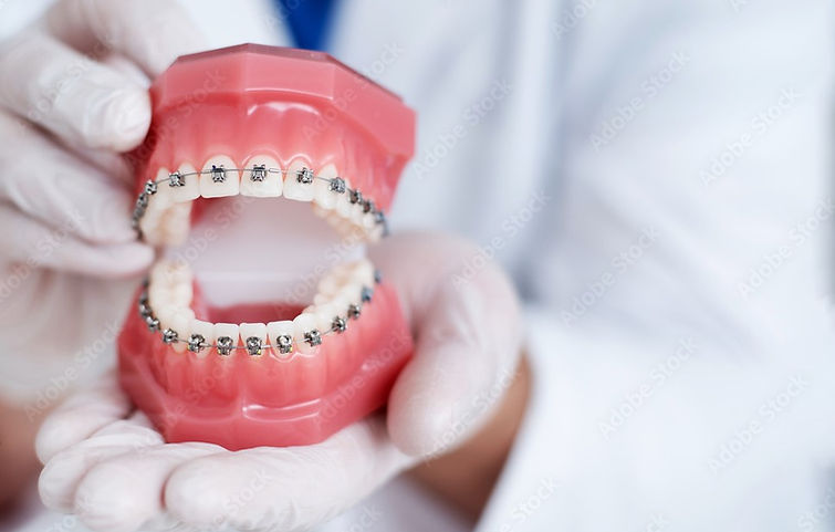 брекети върху зъби