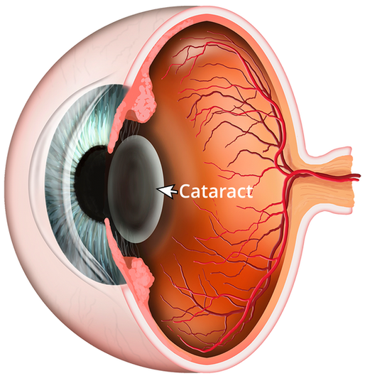 Cataract Surgery in Pune – Expert Care at Centre For Eye