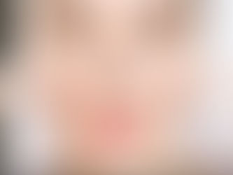 What Is the Best Way to Get Rid of Blackheads?