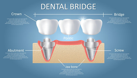 dental bridge