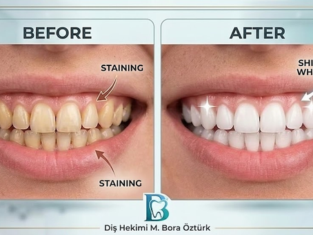 Common Misconceptions About Teeth Whitening: Don't Risk Your Smile!