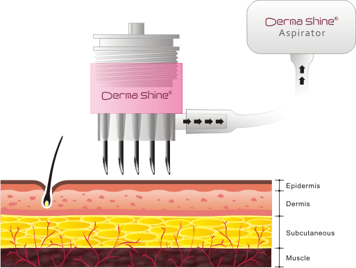 DermaShine_needling_Ani.gif