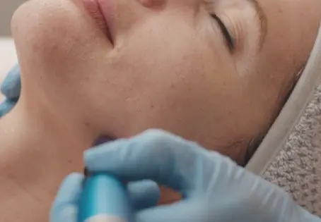 Microneedling: What to Expect Before, During, and After