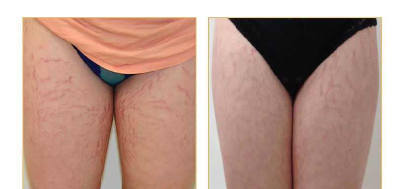 pureskin medical cosmetic clinic before/after results