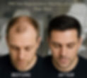 prp_before_after_edited.jpg