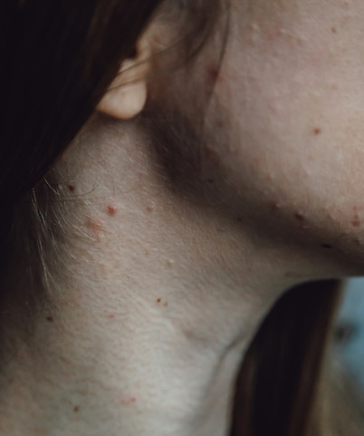 close-up-of-young-woman-having-acne-and-pimples-on-2024-10-16-07-42-00-utc.jpg