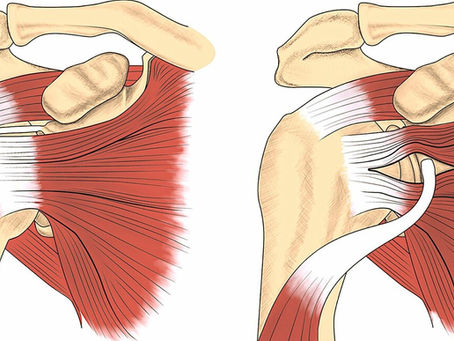Estabilização Dinâmica do Ombro (DAS) para Tratamento da Luxação.