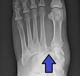 Gap and bony fragment at meta bases