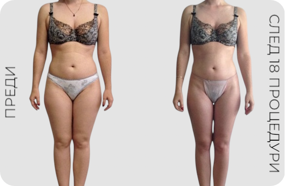 Преди и след курс от Endospheres терапия за тяло – визуално сравнение в областта на бедрата и силуета, Beauty Bar София
