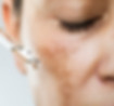 melasma.jpg