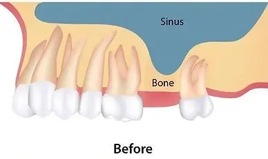 Sinus lift before.webp