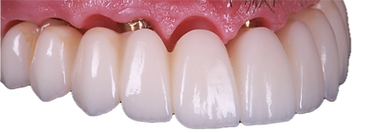 FP1 (Fixed Prosthesis 1) - natural gum line - Optimum Smile Recreation