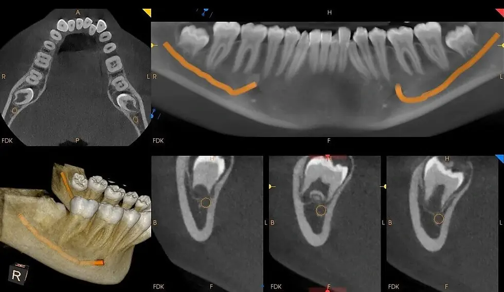 CBCT image showing wisdom tooth root proximity to the inferior alveolar nerve canal,
