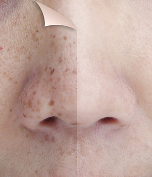 side-by-side image of facial difference after frantional laser procedure