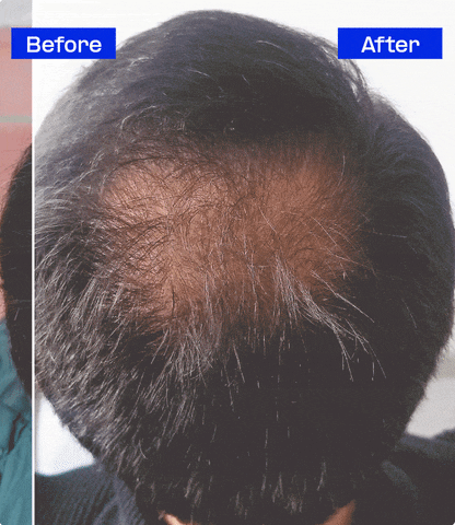 Reverse hair loss unique intelligent extension system