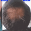 Thumbnail: Reverse hair loss unique intelligent extension system