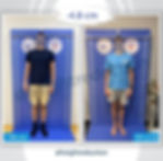 before and after of a height reduction patient