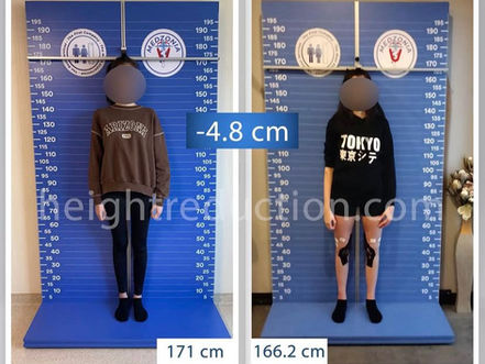 WHAT IS HEIGHT REDUCTION SURGERY? A DETAILED GUIDE