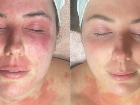 red light therapy for rosacea
