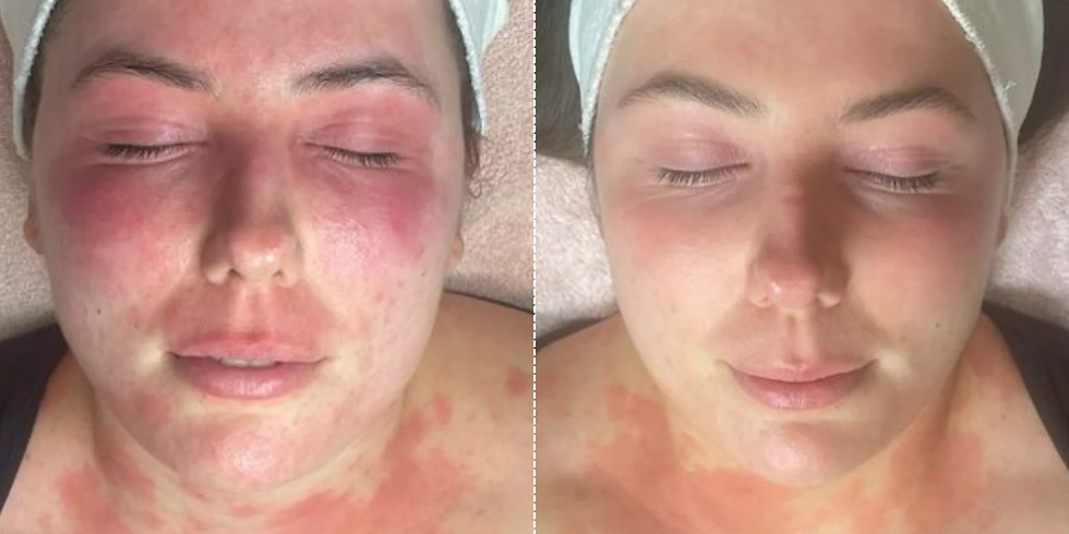red light therapy for rosacea