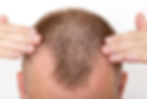 PRP for hair transplants Raleigh