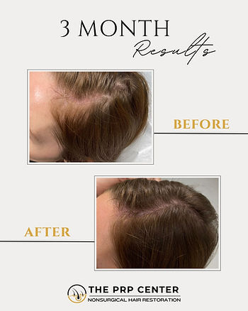The PRP Center Before & After.jpg