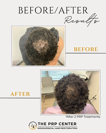 The PRP Center Before & After (4) (1).png