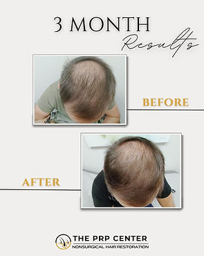 The PRP Center Before & After (2).jpg