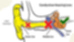 conductive hearing loss