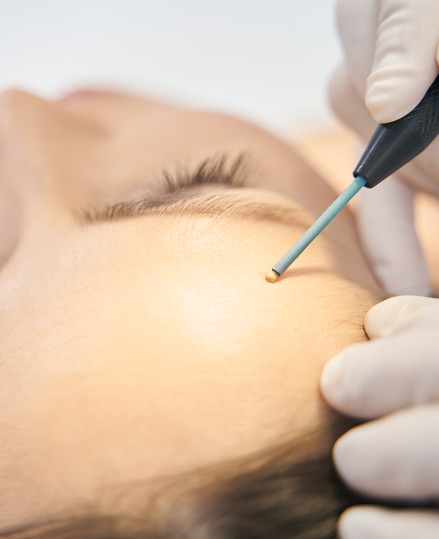 woman-receiving-mole-removal-skincare-treatment-in-2023-11-27-05-23-03-utc.jpg