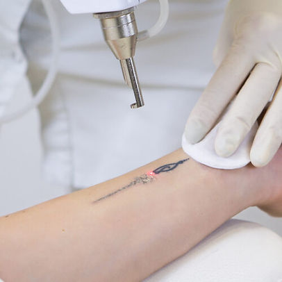 eliminacion de tatuajes.jpeg