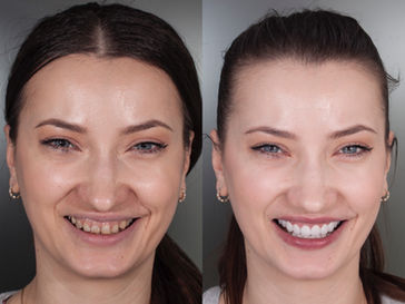 coroane dentare, fatete dentare, dentist Botosani