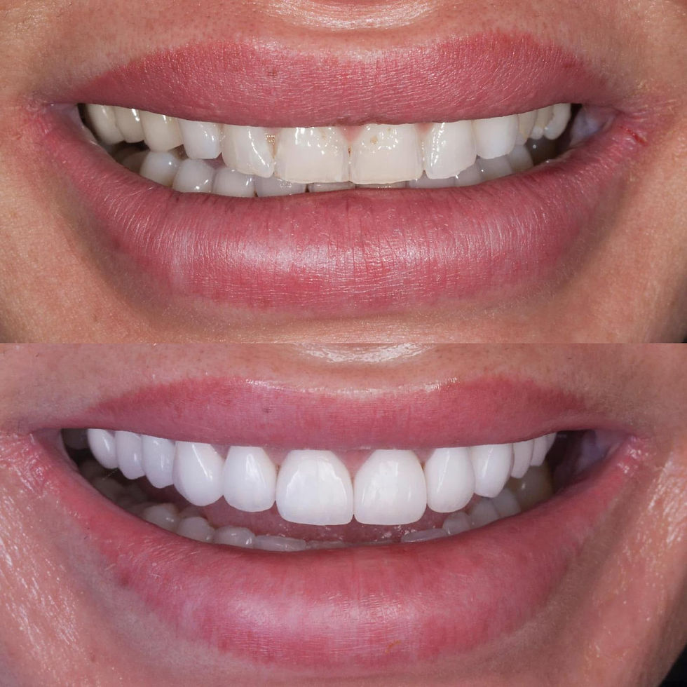 Prim-plan cu fațete ceramice no-prep aplicate pe dinți, vedere laterală