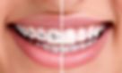 bg-banner-metal-braces-vs-clear_edited.jpg