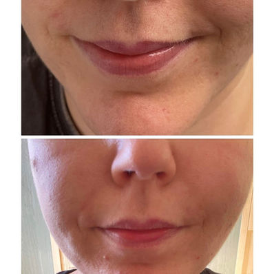 Dermal Filler10.jpg