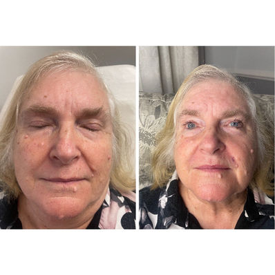 Dermal Filler 11.jpg