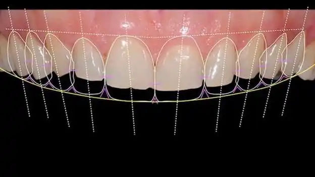 Understanding Smile Design
