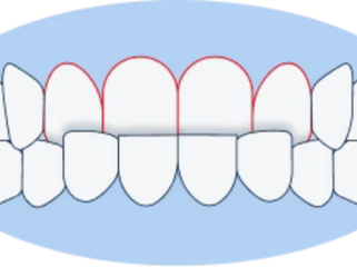 Comprehensive Guide to Crossbites: Understanding Types, Causes, and Treatment Options
