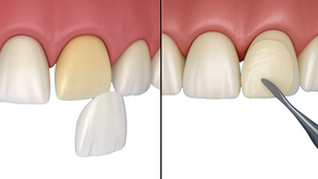 Composite vs. Ceramic Veneers: Which Is Right for You?