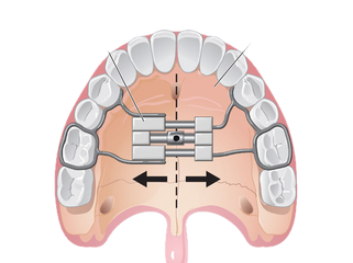 Dental Sealants