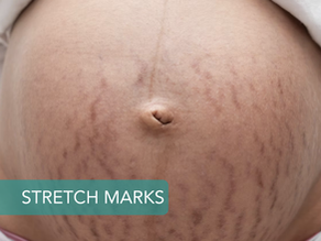 Stretch Marks During Pregnancy: Causes, Treatments, and How to Embrace Them