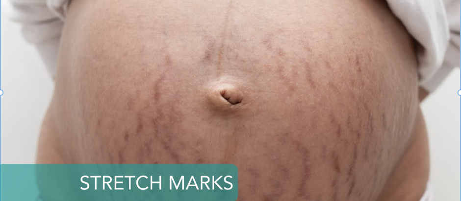 Stretch Marks During Pregnancy: Causes, Treatments, and How to Embrace Them