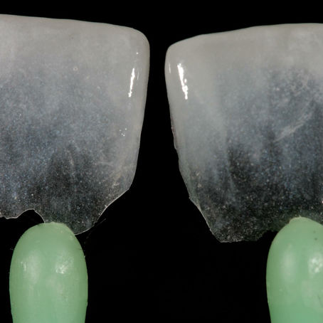 Faccette dentali con o senza digrignamento dei denti?
